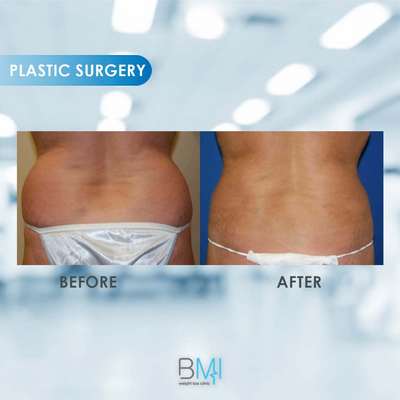4 Liposuction Advanced BMI Beirut Lebanon Dr Nagi Safa