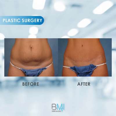 4 Tummy tuck Advanced BMI Beirut Lebanon Dr Nagi Safa