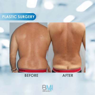 5 Lipo full back Advanced BMI Beirut Lebanon Dr Nagi Safa