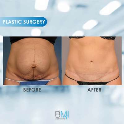 5 Tummy tuck Advanced BMI Beirut Lebanon Dr Nagi Safa