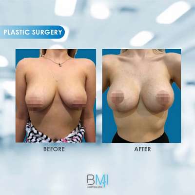 6 Breast Advanced BMI Beirut Lebanon Dr Nagi Safa