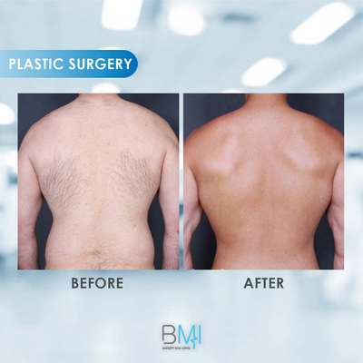 6 Liposuction Advanced BMI Beirut Lebanon Dr Nagi Safa
