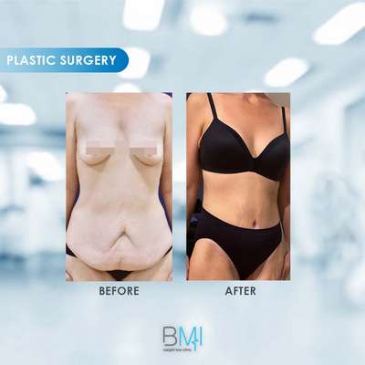 6 Tummy tuck Advanced BMI Beirut Lebanon Dr Nagi Safa