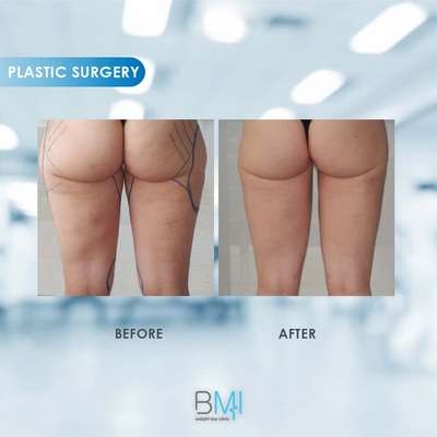 7 Buttock Advanced BMI Beirut Lebanon Dr Nagi Safa