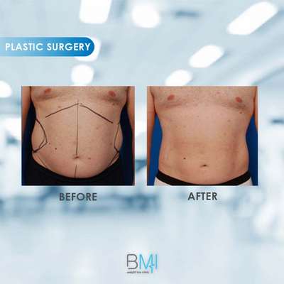 7 Liposuction Advanced BMI Beirut Lebanon Dr Nagi Safa