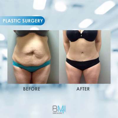 7 Tummy tuck Advanced BMI Beirut Lebanon Dr Nagi Safa