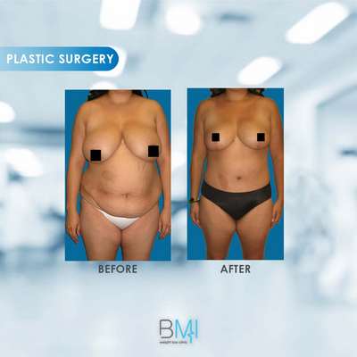 8 Breast Advanced BMI Beirut Lebanon Dr Nagi Safa