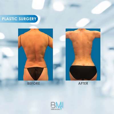 8 Buttock Advanced BMI Beirut Lebanon Dr Nagi Safa