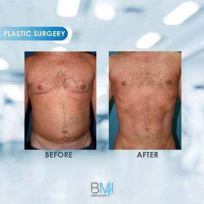 8 Liposuction Advanced BMI Beirut Lebanon Dr Nagi Safa