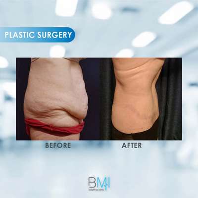 8 Tummy tuck Advanced BMI Beirut Lebanon Dr Nagi Safa