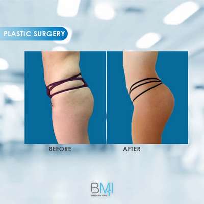 9 Buttock Advanced BMI Beirut Lebanon Dr Nagi Safa