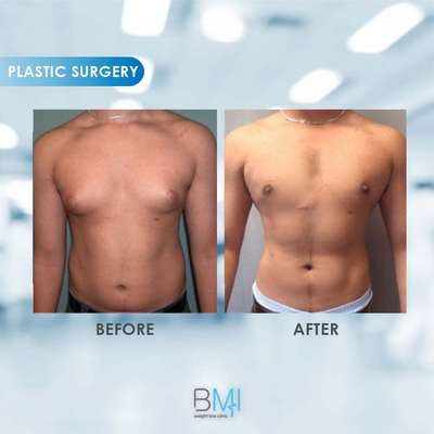 9 Liposuction Advanced BMI Beirut Lebanon Dr Nagi Safa
