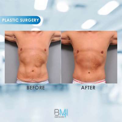 9 Tummy Tuck Advanced BMI Beirut Lebanon Dr Nagi Safa